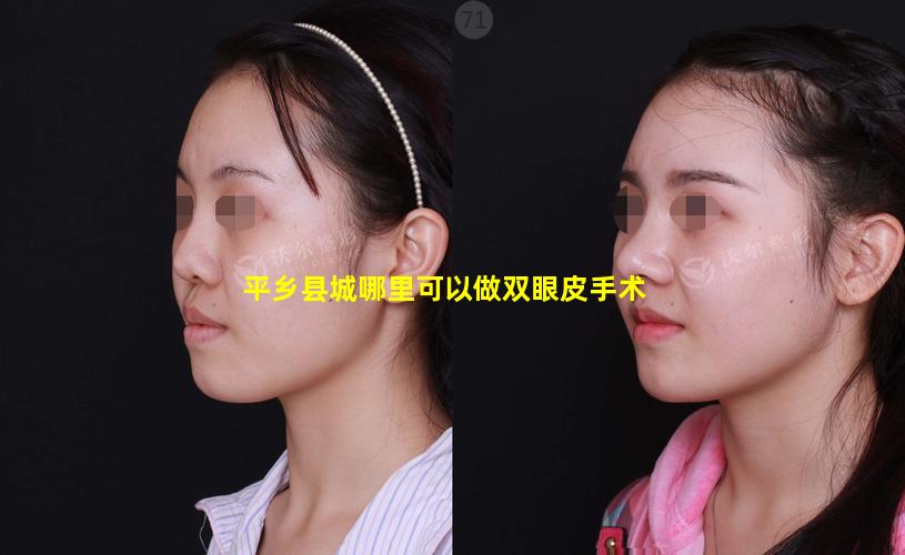 平乡县城哪里可以做双眼皮手术