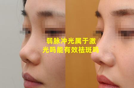 弱脉冲光属于激光吗能有效祛斑吗