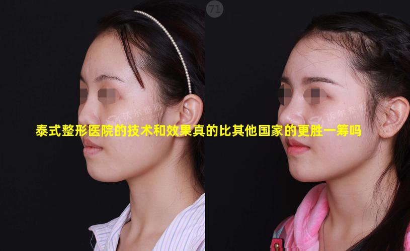 泰式整形医院的技术和效果真的比其他国家的更胜一筹吗