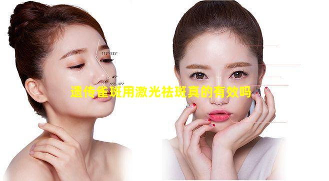 遗传雀斑用激光祛斑真的有效吗
